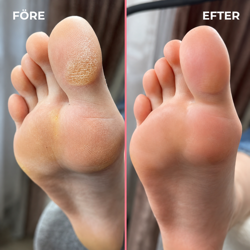 FootRelief – Mjuka fötter på några minuter