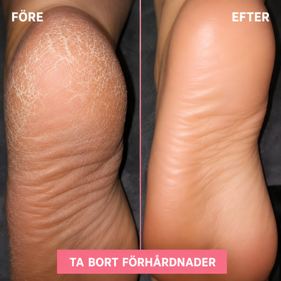 FootRelief – Mjuka fötter på några minuter